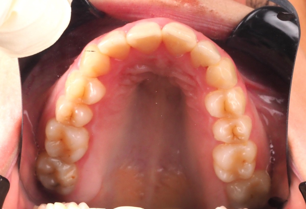 Arcada inferior tratamiento xxx jjjjaa