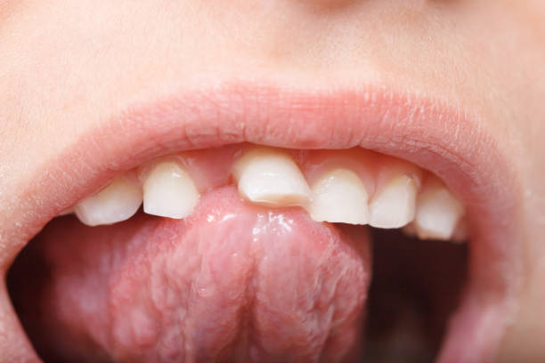 corregir mordida abierta