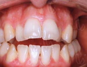 corregir mordida abierta