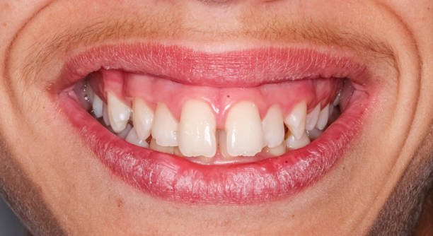Sonrisa con diastema dental entre los incisivos centrales superiores