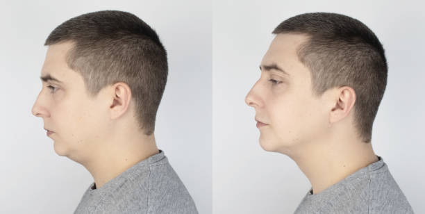 Perfil facial mostrando mandíbula hacia atrás o retrognatia
