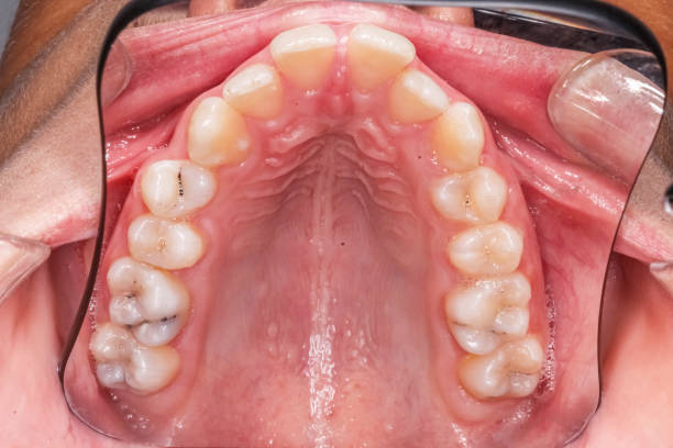 Paladar estrecho en adultos antes y después del tratamiento