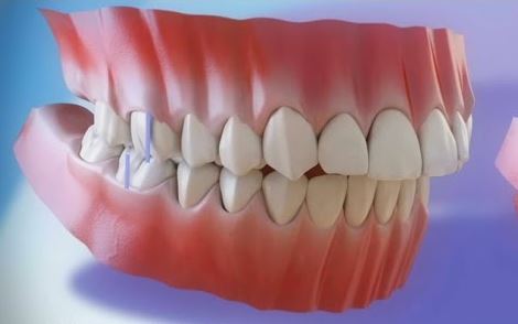 Modelo 3D de maloclusión clase 2 dental con dientes superiores adelantados