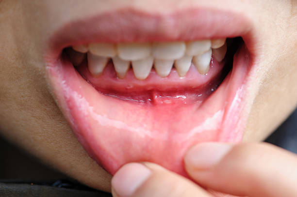 Encías retraídas con recesión gingival visible en la parte inferior