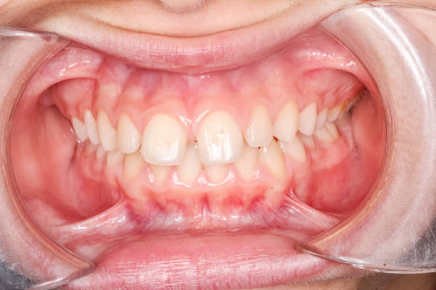 Examen dental que muestra dientes apiñados y mal alineados, un caso típico de maloclusión