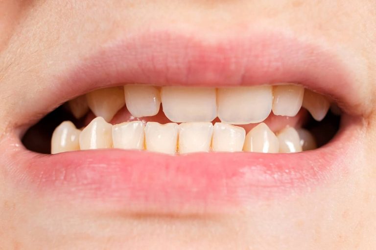 Primer plano de mordida cruzada anterior con dientes inferiores por delante de los superiores