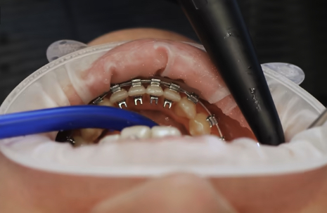 Modelo 3D de turbos dentales metálicos colocados sobre los incisivos superiores en ortodoncia