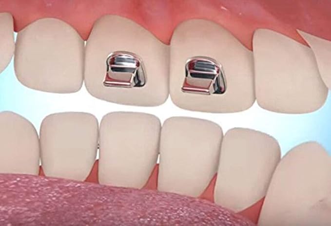 Modelo 3D de turbos dentales metálicos colocados sobre los incisivos superiores en ortodoncia