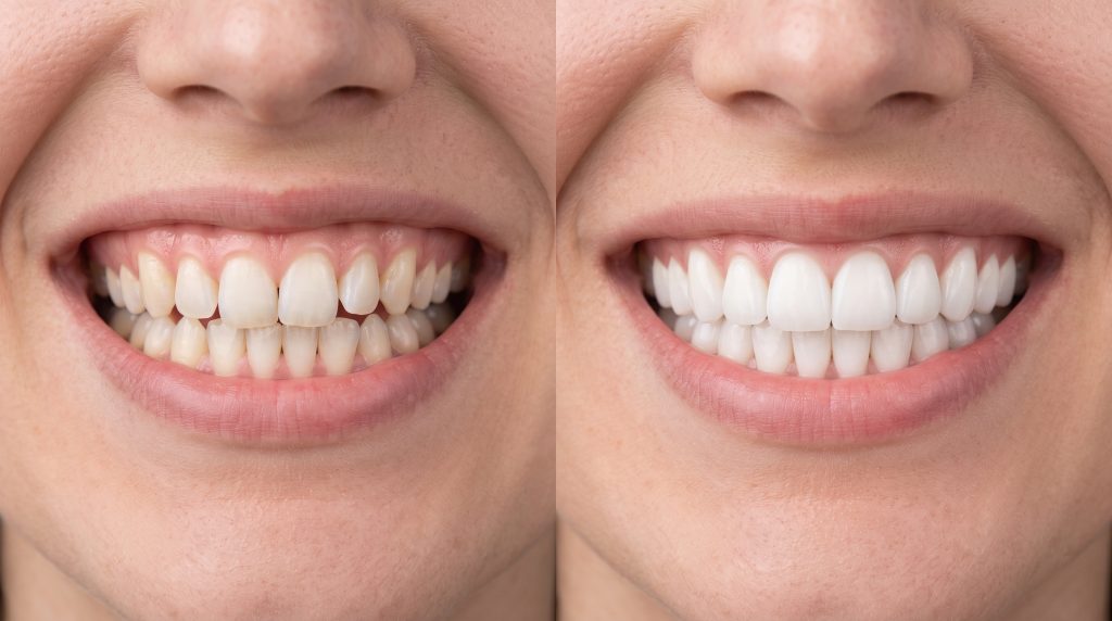 Comparativa antes y después de ortodoncia invisible con apiñamiento dental corregido