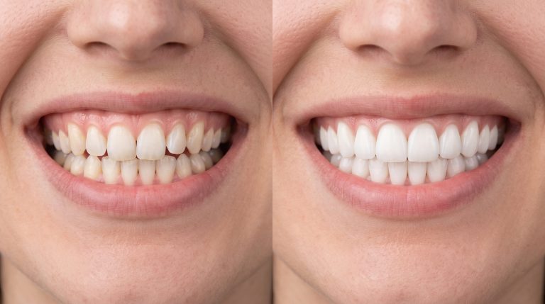 Comparativa antes y después de ortodoncia invisible con apiñamiento dental corregido