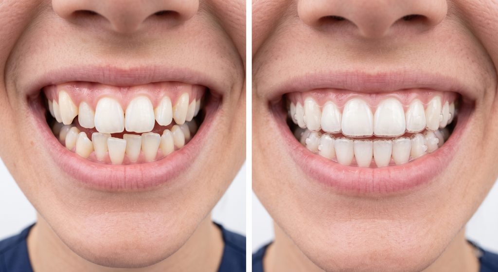 Antes y después de ortodoncia invisible con alineadores transparentes corrigiendo apiñamiento dental