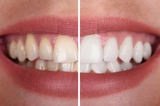 Antes y después de blanqueamiento dental en Barcelona con dientes notablemente más blancos